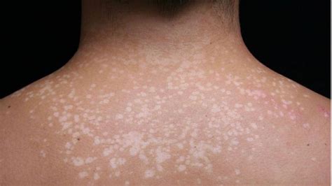 What Is Tinea Versicolor Common Causes Symptoms And Home Remedies To