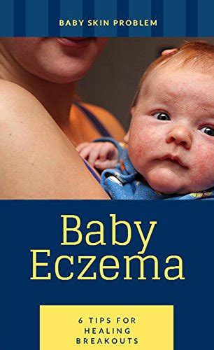 Baby Skin Problem Baby Eczema 6 Tips For Healing Breakouts Ebook