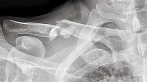 Ever Wondered What A Broken Collarbone Feels Like I Did The Research