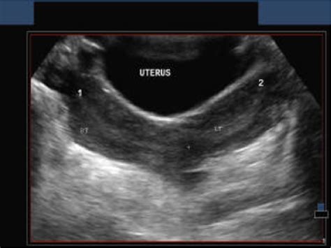 Pelvic Ultrasound Female Pelvic Ultrasound Of A Female Who Is 28