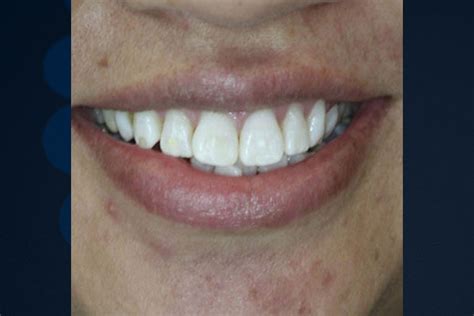 Before And After Photos Bluegrass Dentistry Lexington Ky