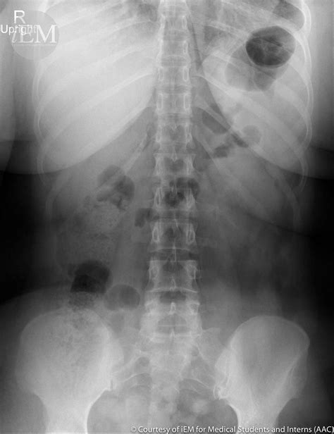 Normal Abdominal X Ray Child With Punctate Opacities In The Colon