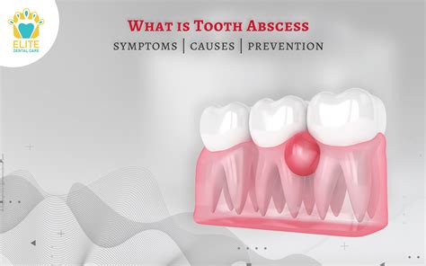 What Are Tooth Abscess Symptoms Causes And Prevention Elite Dental