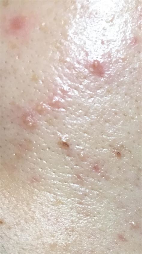 Rosacea Type 2 Fungal Acne Perioral Dermatitis Demodex Mites Little