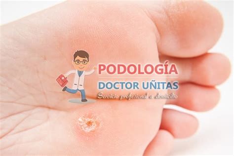 Tratamientos Para Papiloma O Verruga Plantar Podologia Doctor Uñitas