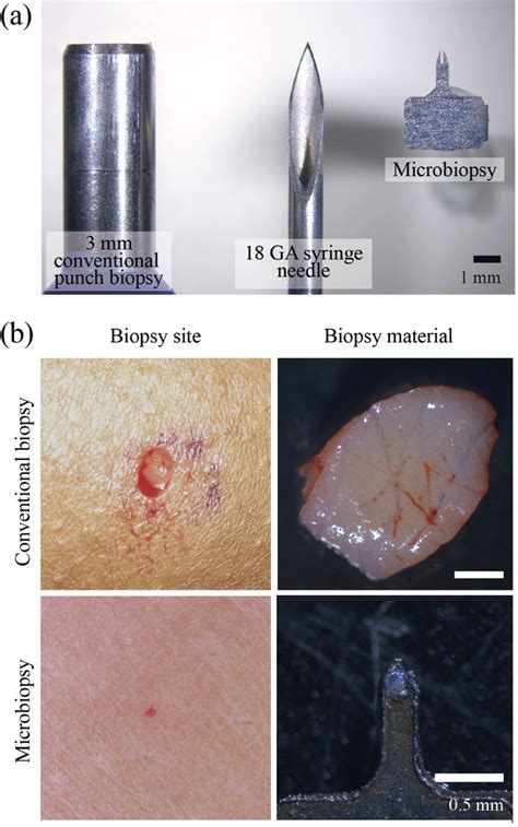 View 12 Skin Punch Biopsy Scar Zenidrat