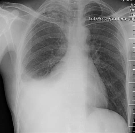 Pleural Effusion Chest X Ray Wikidoc