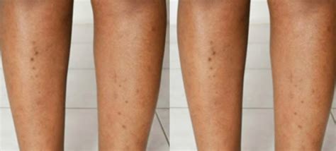 Why Dark Spots On Leg Bottom Of Feet And Cures Skincarederm