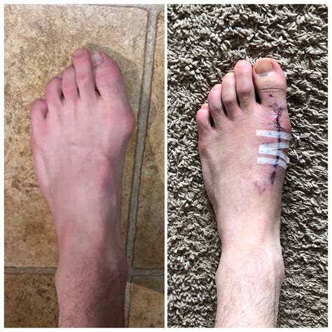 2 Weeks Post Surgery Bunionectomy Rsurgery