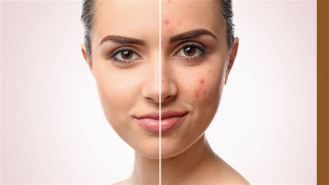 15 Effective Ways To Get Rid Of Pimples And Achieve Clear Skin