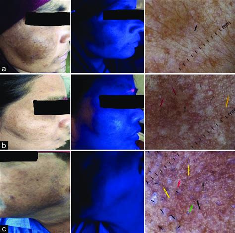 Clinical Wood S Lamp And Corresponding Dermoscopic Images In The Three