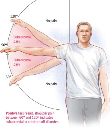 Shoulder Impingement Causes Symptoms Diagnosis Treatment Health Rxharun
