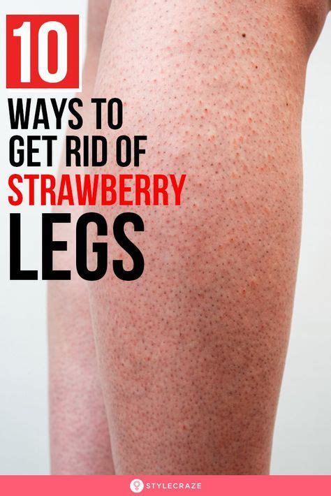 10 Natural Ways To Get Rid Of Strawberry Legs Strawberry Legs Beauty