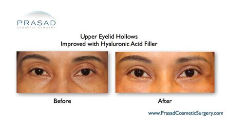 Upper Eyelid Filler Before And After Photos New York