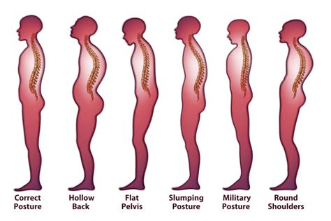 You'll learn how to fix your posture, find relief from pain and correct movement dysfunction. How's Your Posture? | SportsCare Physical Therapy