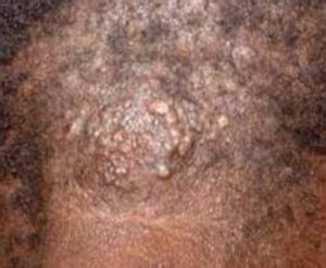 Feel something weird under all that hair? Itchy Bumps on Scalp, Neck, Causes, Red, Hurts, Pictures ...