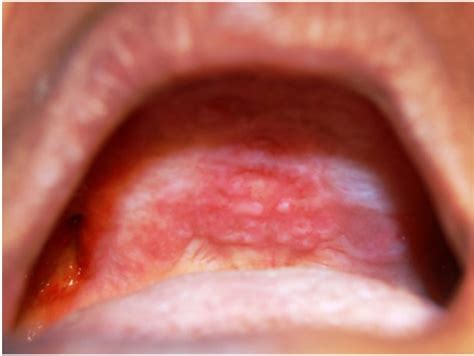 Oral Lesions In The Hard Palate And Maxillary Alveolar Ridge
