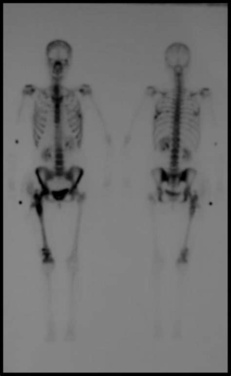 Image Bone Scintigraphy Of The Whole Body Msd Manual Professional