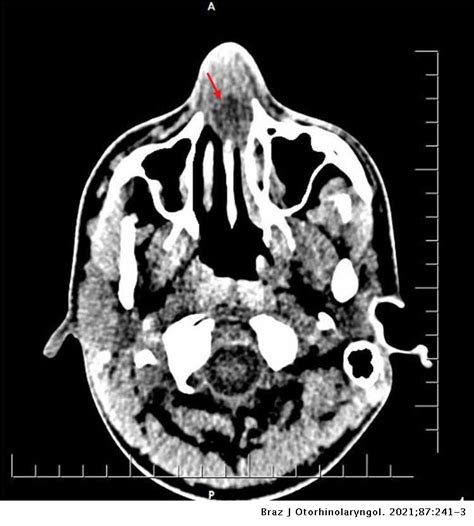Nasal Septal Abscess Uncommon Localization Of Extraintestinal