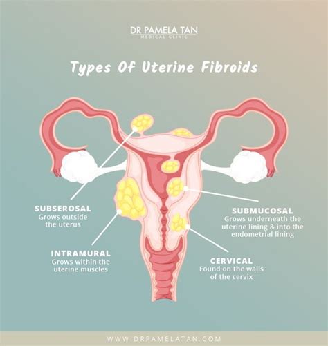 Pin On Obstetrics Gynecology Infographics