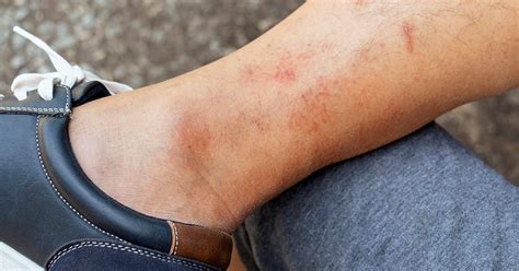 Can Leggings Cause Rash On Skin