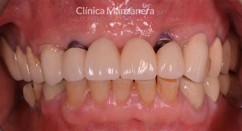Caso Cl Nico Extracci N Y Reposici N Puente Dental Sobre Implantes