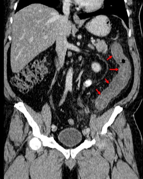 Acute Diverticulitis Radiology Cases