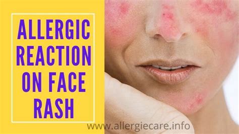 Allergic Reaction On Face Rash Why And Cure Allergie Care