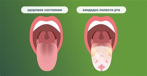 Жжение во рту и на языке причины какой болезни лечение Почему печет губы горло небо десны