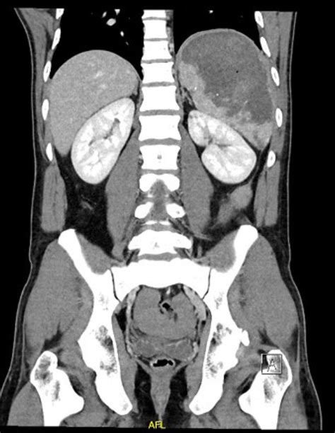 Splenic Abscess As A Possible Sequela Of Covid 19 A Case Series