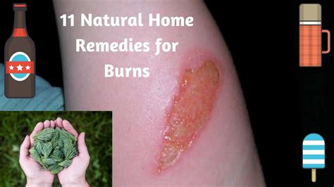 11 Natural Home Remedies For Skin Burns Skin Burns Treatment Youtube