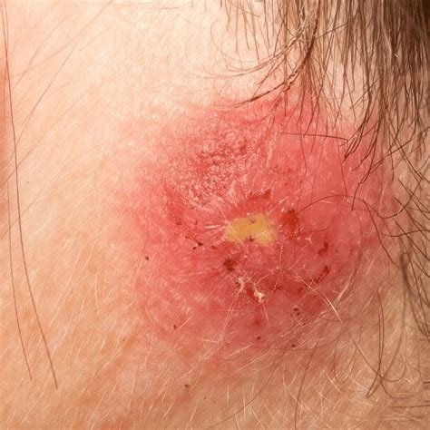 Could A Lump Be A Staph Infection Urgentmed