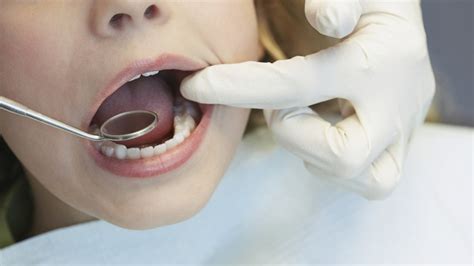 Voir plus d'idées sur le thème dentaire, cabinet dentaire, dentiste. Caries enfant : comment les prévenir, détecter et soigner ...
