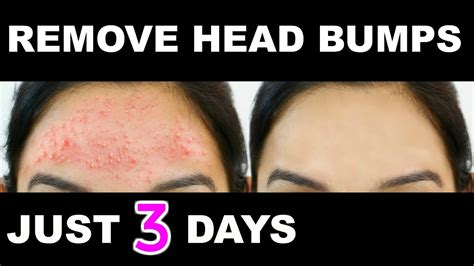 How To Get Rid Of Small Pimples Head Bumps Fast Naturally Anaysa