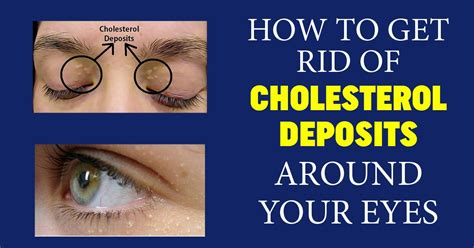 How To Get Rid Of Cholesterol Deposits Around Your Eyes What Causes