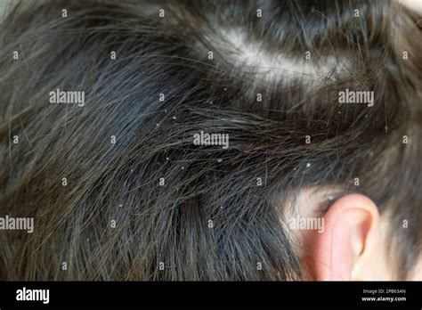 Dandruff In Kid Hair Flaky Scalp Childrens Dandruff Seborrheic