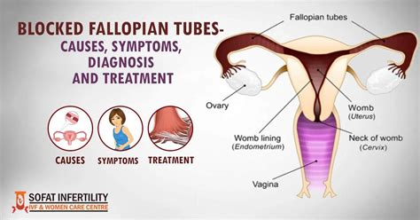 Blocked Fallopian Tubes Causes Symptoms Diagnosis And Treatment