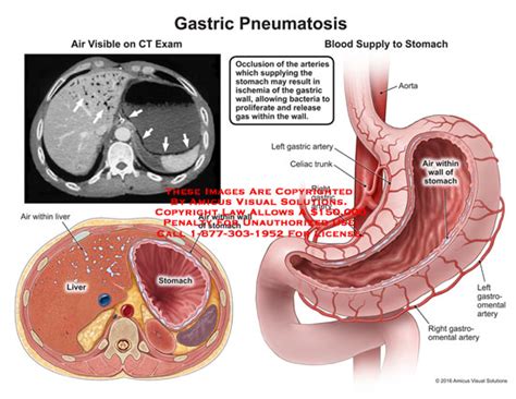 The arteries going from the right ventricle take blood to the lungs. AMICUS Illustration of amicus,injury,gastric,pneumatosis,air,visible,ct,liver,stomach,wall,blood ...