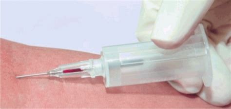 Safety shield is already aligned with the bevel of the bd vacutainer flashback needle, so no extra assembly or adjustment is required by the user. BD Vacutainer Flashback Blood Collection Needle 21g x 1