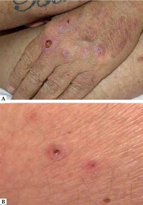 Acquired Perforating Dermatosis In A Patient With Chronic Renal Failure