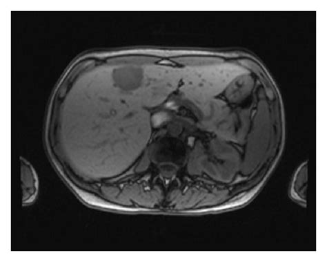 T1 Hypointense Liver Lesion On Mri Download Scientific Diagram