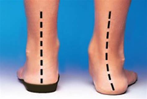 Flat Feet Surgery Pros And Cons Gongalves