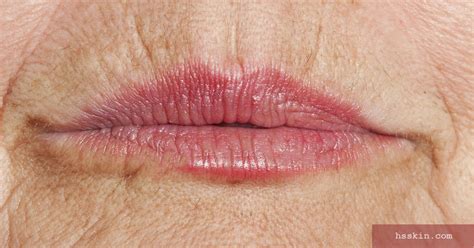 Causes Of Upper Lip Wrinkles And Best Treatments Thrive Skin Wellness