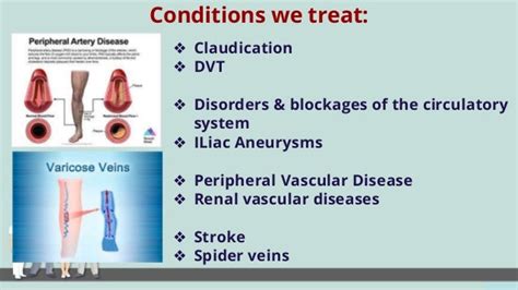 Facilities And Services For Varicose Veins And Stroke Treatment In Indore