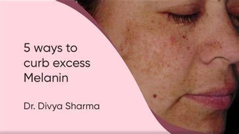 5 Tips To Reduce Excess Melanin Reduce Melanin In Body Permanently By