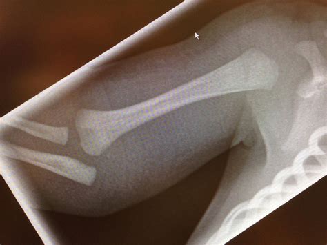 Distal Humerus Physeal Separation Pediatric Pediatrics Orthobullets