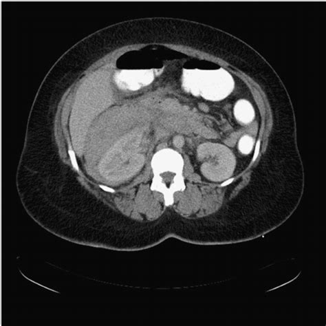 Ct Scan Showing A Large Perinephric Haematoma Encapsulating The Right