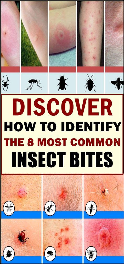 Discover How To Identify The 8 Most Common Insect Bites Insect Bites
