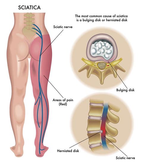 Sciatica Pinched Nerve Causes Symptoms And Treatments