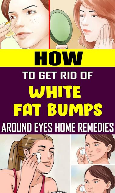How To Get Rid Of White Fat Bumps Around Eyes Naturally Healthy Lifestyle